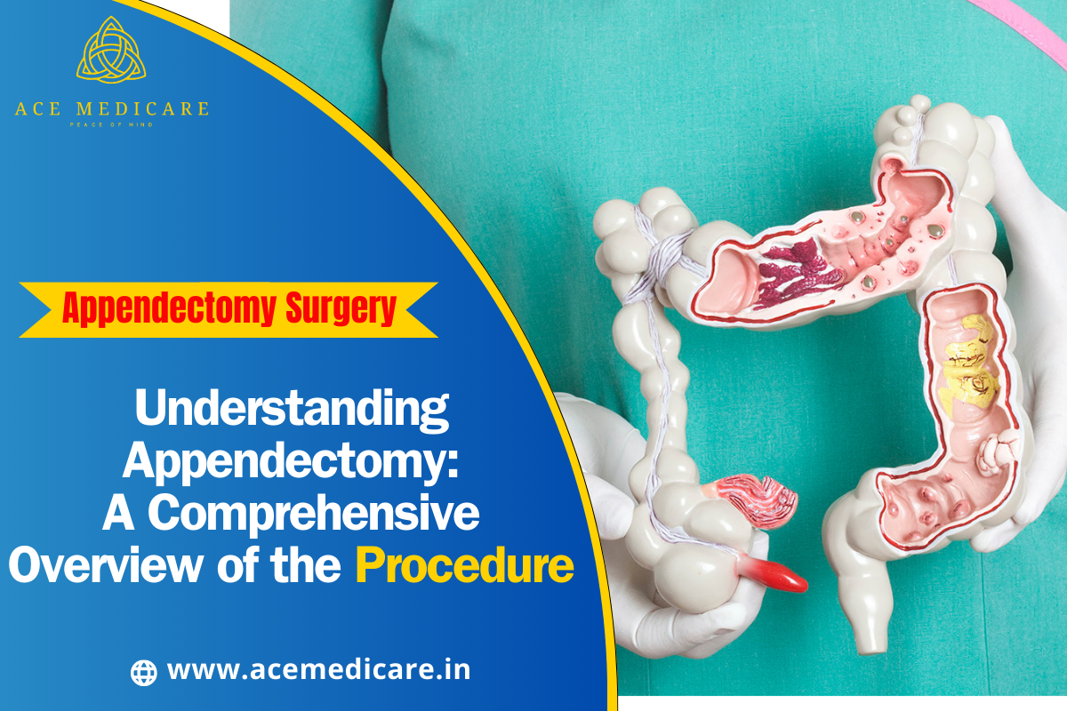 Understanding Appendectomy: A Comprehensive Overview of the Procedure